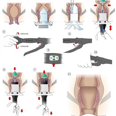 Циркулярные сшивающие аппараты для геморроидопексии и лечения пролапса.