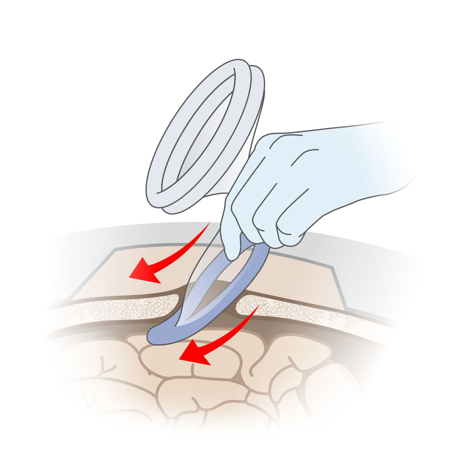 Согните и поместите гибкое синее кольцо в полость операционной раны